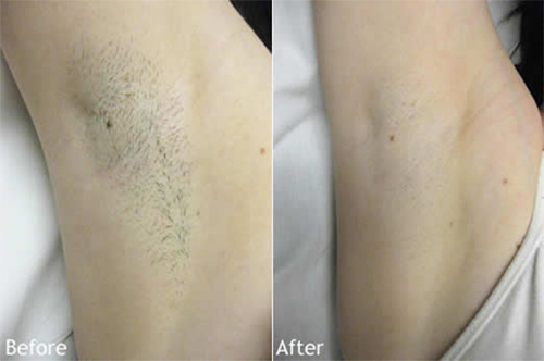 Công thức giúp trị thâm vùng nách đơn giản và tiết kiệm cong-thuc-giup-tri-tham-vung-nach-don-gian-va-tiet-kiem-ket-qua