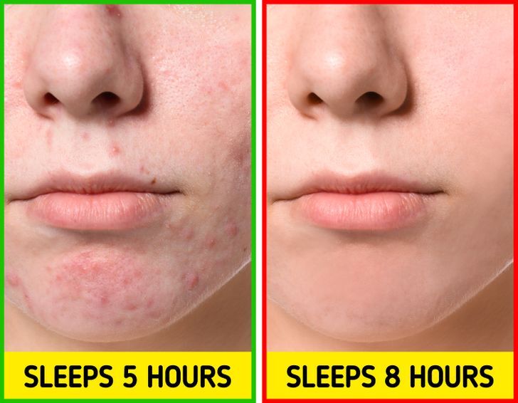6+ nguyên nhân gây ra mụn mà bạn không ngờ tới 6+ nguyên nhân gây ra mụn mà bạn không ngờ tới - Yêu Hàng Ngoại