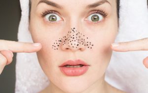 Top 7 sai lầm khiến bạn không thể loại bỏ mụn đầu đen - Yêu Hàng Ngoại