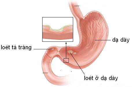 Người đau dạ dày nên ăn uống gì? Cách làm giảm đau dạ dày hiệu quả? Người đau dạ dày nên ăn uống gì? Cách làm giảm đau dạ dày hiệu quả? - Yêu Hàng Ngoại