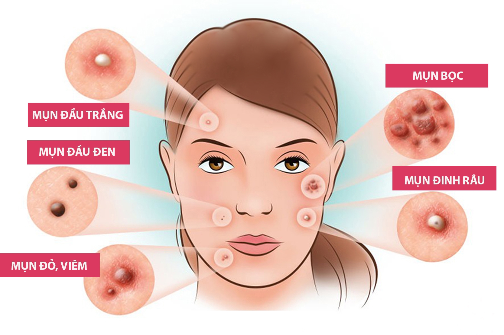 Quy trình Skincare chăm sóc da sau khi nặn mụn đúng chuẩn nhất Quy trình Skincare chăm sóc da sau khi nặn mụn đúng chuẩn nhất - Yêu Hàng Ngoại