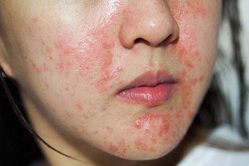 Da nhạy cảm là gì? Các bước skincare chăm sóc cho da nhạy cảm Da nhạy cảm là gì? Các bước skincare chăm sóc cho da nhạy cảm - Yêu Hàng Ngoại