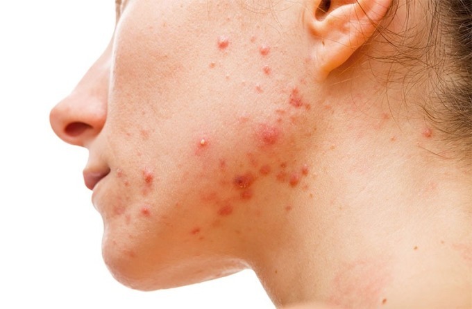 6 tác hại thường thấy khi không thoa kem chống nắng thường xuyên 6 tác hại thường thấy khi không thoa kem chống nắng thường xuyên - Yêu Hàng Ngoại