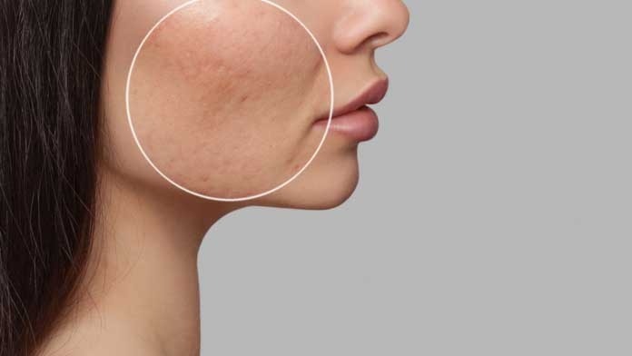 Những nguyên nhân gây bít lỗ chân lông bạn nên biết Những nguyên nhân gây bít lỗ chân lông bạn nên biết - Yêu Hàng Ngoại